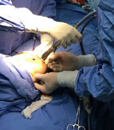 鄭州麗天整形美容醫(yī)院仝茂盛面部吸脂案例效果分享