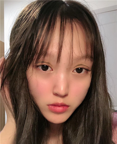 慈溪悅爾醫(yī)學美容醫(yī)院做雙眼皮術后眼睛還未完全消腫