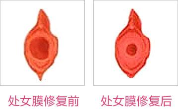 成都東方整形處女膜修復(fù)怎么樣？處女膜修復(fù)術(shù)后如何護(hù)理？