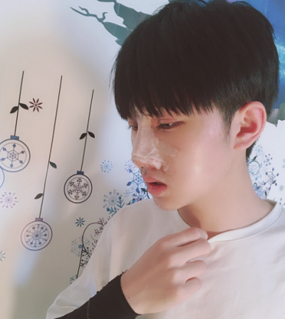 長(zhǎng)春中妍醫(yī)療美容醫(yī)院做鼻綜合手術(shù)慢慢恢復(fù)中