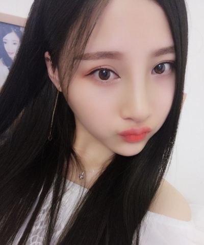 鄭州麗天整形美容醫(yī)院仝茂盛面部吸脂案例效果分享