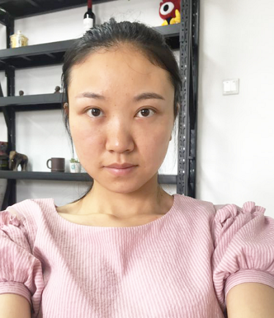 蘇州同濟(jì)醫(yī)院整形美容中心胡慧敏去眼袋案例效果分享