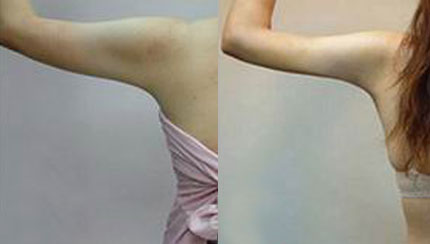  成都春語整形做手臂吸脂治術(shù)后效果好嗎？