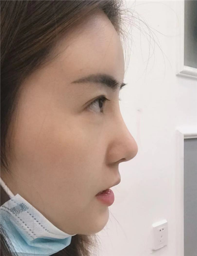 煙臺壹美整形美容醫(yī)院楊彪炳隆鼻案例效果分享