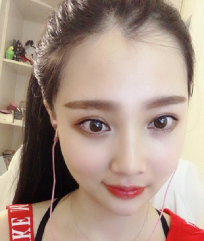 鄭州麗天整形美容醫(yī)院做面部吸脂手術(shù)后的半個(gè)月