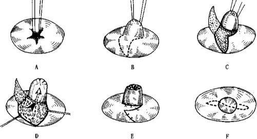 成都韓美醫(yī)療做巨乳縮小術(shù)效果如何有多少方法？