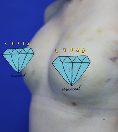 煙臺(tái)壹美整形美容醫(yī)院做隆胸手術(shù)后的側(cè)面情況