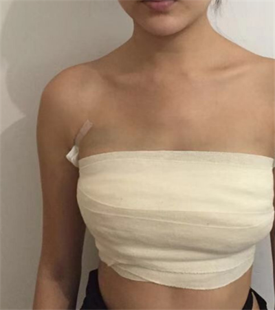 寧波珈禾整形?？漆t(yī)院做隆胸手術(shù)前的胸部狀態(tài)