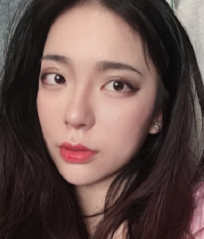 成都漢密爾頓美容醫(yī)院做鼻修復(fù)手術(shù)后的最終效果