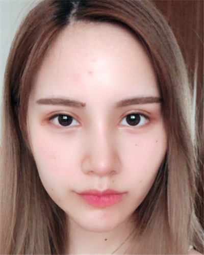 深圳弘美醫(yī)療美容門(mén)診部做眼綜合手術(shù)后半個(gè)月