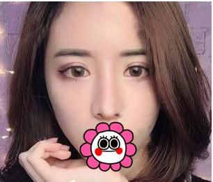 有“鼻王”之稱的楊群申做鼻子到底怎么樣？隆鼻前后圖片