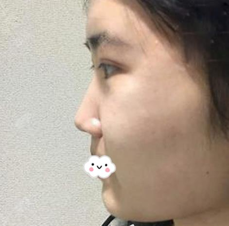 假體隆鼻假嗎？假體隆鼻三個月效果分享