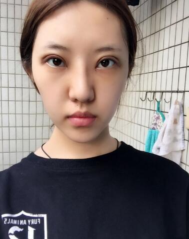 第四軍醫(yī)大學(xué)唐都醫(yī)院李望舟雙眼皮案例術(shù)后一個(gè)月效果