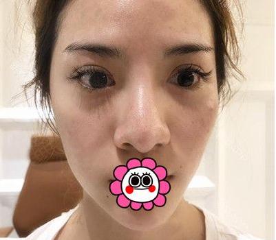 宜昌奧萊整形楊群申膨體隆鼻案例術(shù)前效果