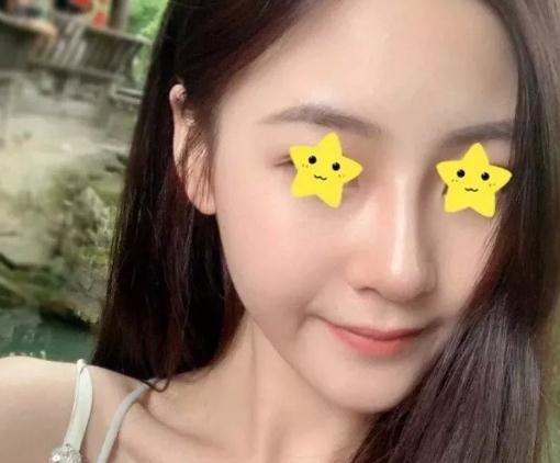 做綜合鼻，上海首爾麗格安建榮鼻綜合真人案例照片