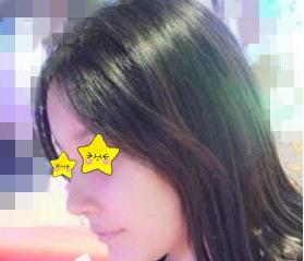 長沙亞韓鄭京湘隆鼻術(shù)后兩個(gè)月 長沙亞韓鄭京湘隆鼻術(shù)后兩個(gè)月