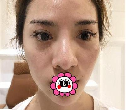 有“鼻王”之稱的楊群申做鼻子到底怎么樣？隆鼻前后圖片