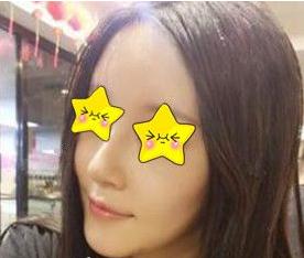 長沙亞韓鄭京湘隆鼻術(shù)后一個(gè)月 長沙亞韓鄭京湘隆鼻術(shù)后一個(gè)月