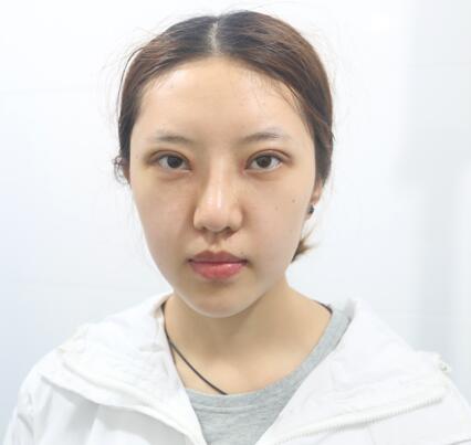 第四軍醫(yī)大學(xué)唐都醫(yī)院李望舟雙眼皮案例術(shù)后一周