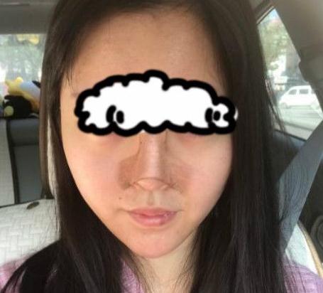 北京聯(lián)合麗格卓彥醫(yī)療趙瓊隆鼻失敗修復(fù)手術(shù)案例手術(shù)當(dāng)天 北京聯(lián)合麗格卓彥醫(yī)療趙瓊隆鼻失敗修復(fù)手術(shù)案例手術(shù)當(dāng)天