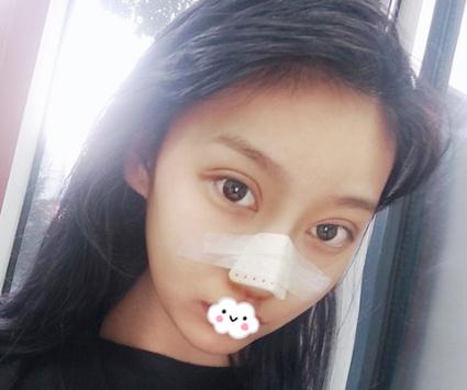 在上海伊美爾港華做假體隆鼻術后兩天效果