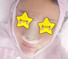 長沙亞韓鄭京湘隆鼻術(shù)后第二天 長沙亞韓鄭京湘隆鼻術(shù)后第二天