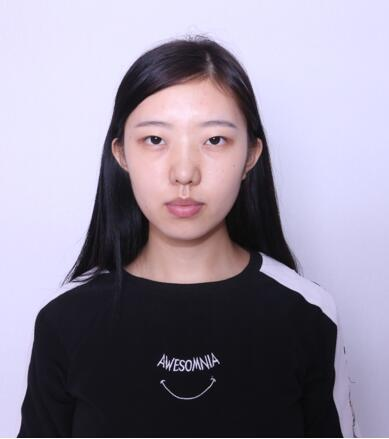 做雙眼皮案例，第四軍醫(yī)大學(xué)唐都醫(yī)院李望舟雙眼皮案例圖片