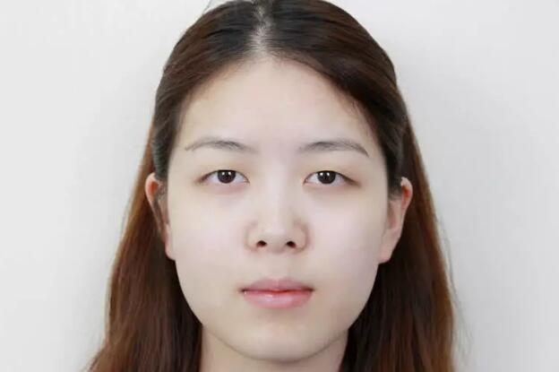 做雙眼皮案例，鄭州壹加壹王洛生全切雙眼皮案例圖片