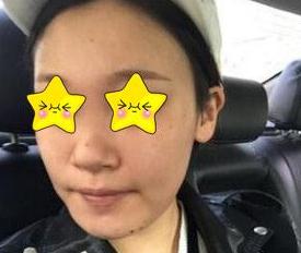 長沙亞韓鄭京湘隆鼻案例術(shù)前 長沙亞韓鄭京湘隆鼻案例術(shù)前