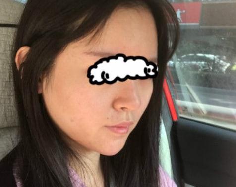 北京聯(lián)合麗格卓彥醫(yī)療趙瓊隆鼻失敗修復(fù)手術(shù)案例術(shù)后半個月 北京聯(lián)合麗格卓彥醫(yī)療趙瓊隆鼻失敗修復(fù)手術(shù)案例術(shù)后半個月