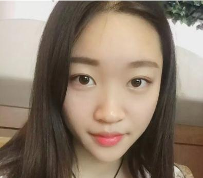 宜昌奧萊楊群申超體隆鼻案例分享，有圖