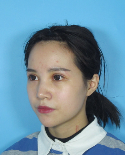 成都美立方（原華博）醫(yī)療美容醫(yī)院做眼部修復(fù)手術(shù)拆線后