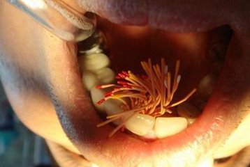 撫州英倫口腔根管治療怎么樣？根管治療有什么優(yōu)點(diǎn)？