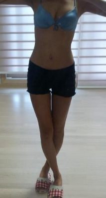 東莞華美醫(yī)療美容醫(yī)院做腰腹吸脂手術(shù)后的最終情況