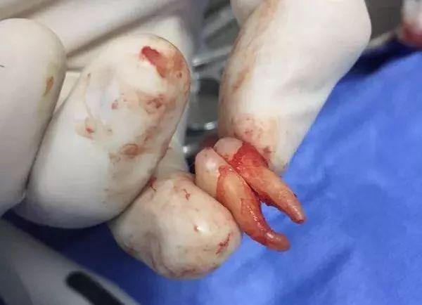 福州登特口腔拔智齒有哪些利弊？拔智齒有哪些情況？