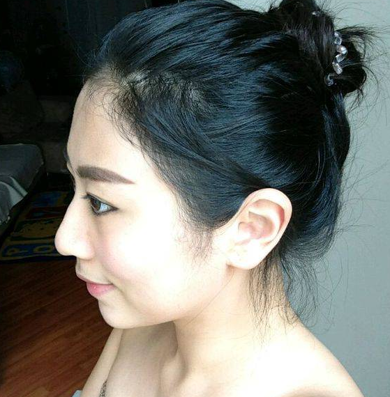 南京美貝爾醫(yī)療美容醫(yī)院做假體隆鼻術(shù)后一個(gè)月的形態(tài)