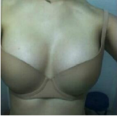 長沙愛思特醫(yī)療美容醫(yī)院做假體隆胸術后最終效果