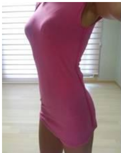 東莞華美醫(yī)療美容醫(yī)院做腰腹吸脂術(shù)后的腰部