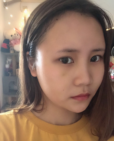 上海美萊醫(yī)療美容門診部做面部填充術(shù)后的日?；謴?fù)