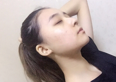 北京京民醫(yī)院（原釣魚臺醫(yī)院）整形外科做下頜骨手術后去掉頭套