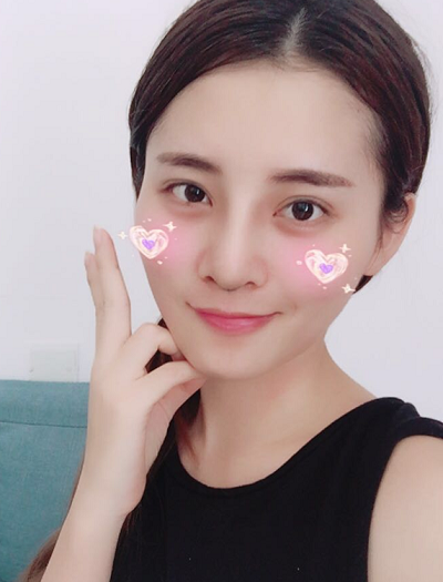 深圳微姿醫(yī)療美容門診部做鼻綜合手術(shù)拆線后第三天