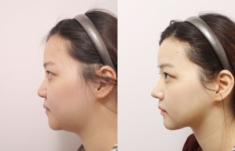 面部吸脂最好的辦法是什么？做一次面部吸脂多少錢？