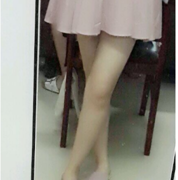  東莞華美醫(yī)療美容醫(yī)院做大腿吸脂手術(shù)后的最終效果