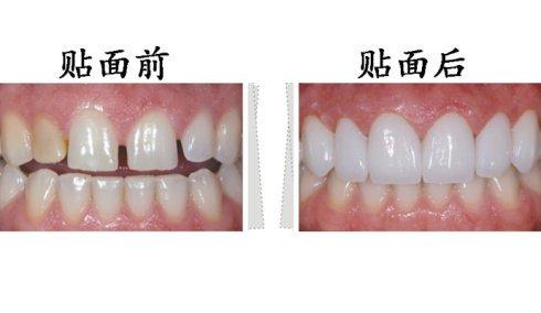 東莞拜博口腔瓷貼面有什么優(yōu)勢(shì)？瓷貼面有副作用嗎？