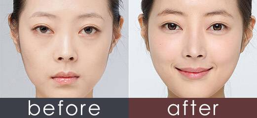 玻尿酸填充蘋(píng)果肌后效果能保持多久？想豐蘋(píng)果肌是自體好一點(diǎn)還是玻尿酸好一點(diǎn)？