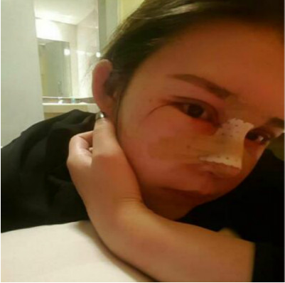 成都美立方（原華博）醫(yī)療美容醫(yī)院做肋軟骨隆鼻手術(shù)后的第三天