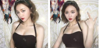  武漢米蘭醫(yī)療美容門診部陳家宏做假體隆胸案例效果分享