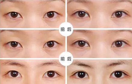 貴州旭美人整形埋線(xiàn)雙眼皮優(yōu)點(diǎn)有哪些如何選擇？