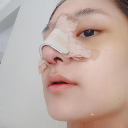 成都蜀尚蓉雅美容整形醫(yī)院做鼻綜合剛剛結(jié)束手術(shù)