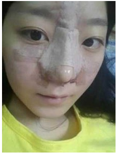 上海時光整形外科醫(yī)院做耳軟骨隆鼻術后剛剛結(jié)束 上海時光整形外科醫(yī)院做耳軟骨隆鼻術后剛剛結(jié)束